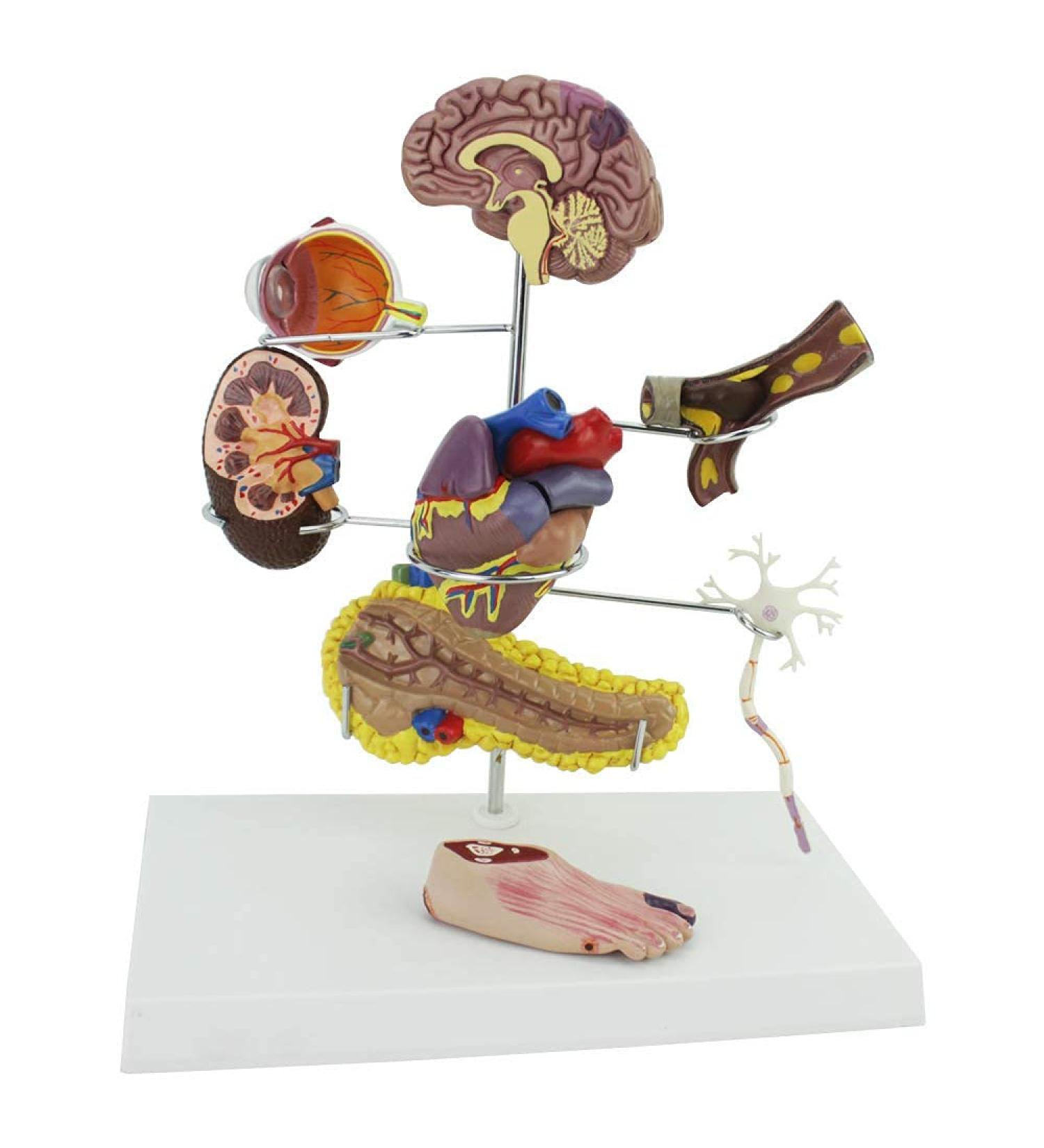 Model of Diabetes Model of complications Brain Heart Pancreas neurone Foot Patient Patient Doctor aids to The Demonstration of Diabetes - Buy Online on SooperMarket.com