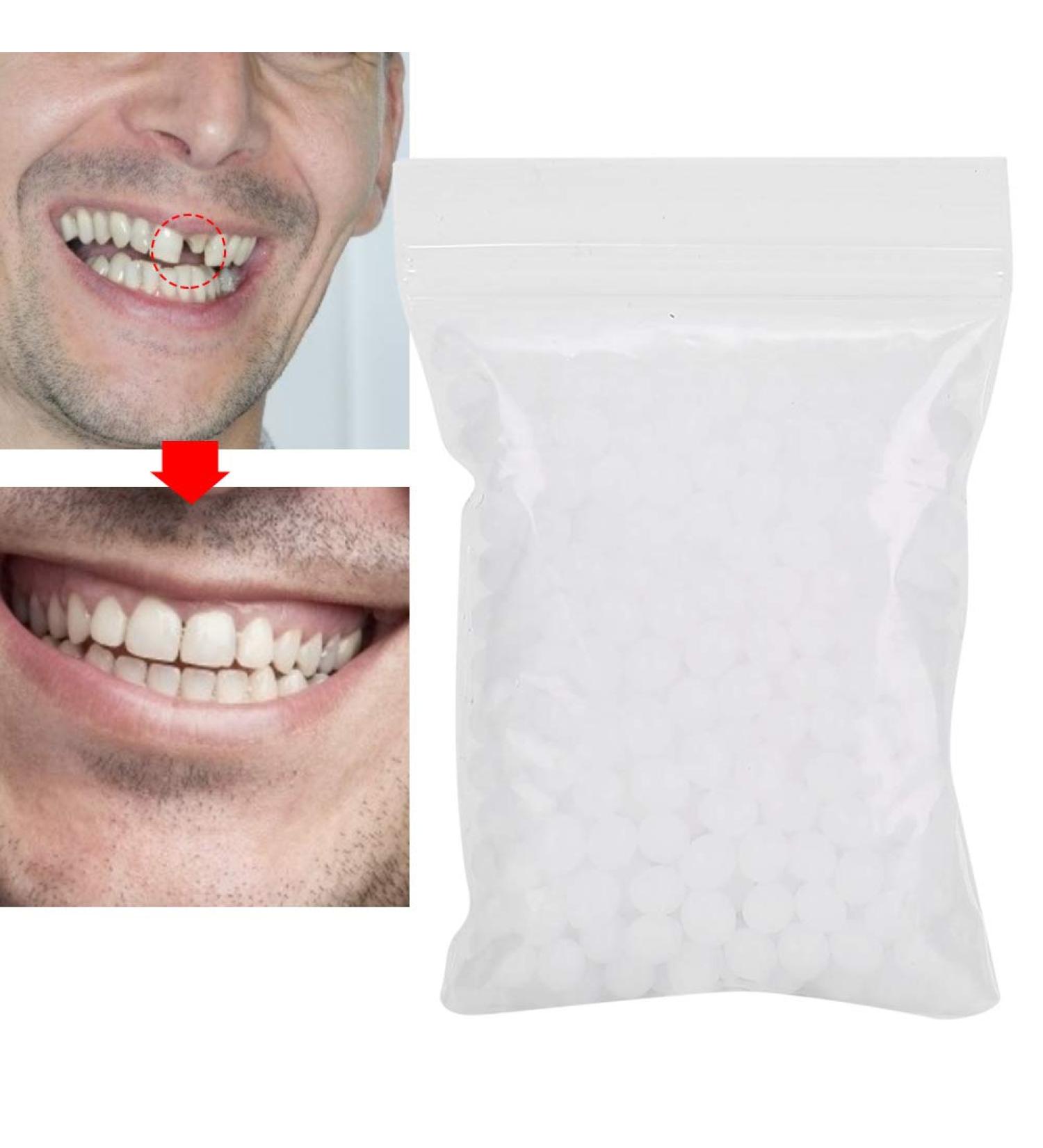 Temporary Tooth Repair Beads - 10g Filling Material for Missing/Broken Teeth - Replacement Kit - Buy Online on SooperMarket.com