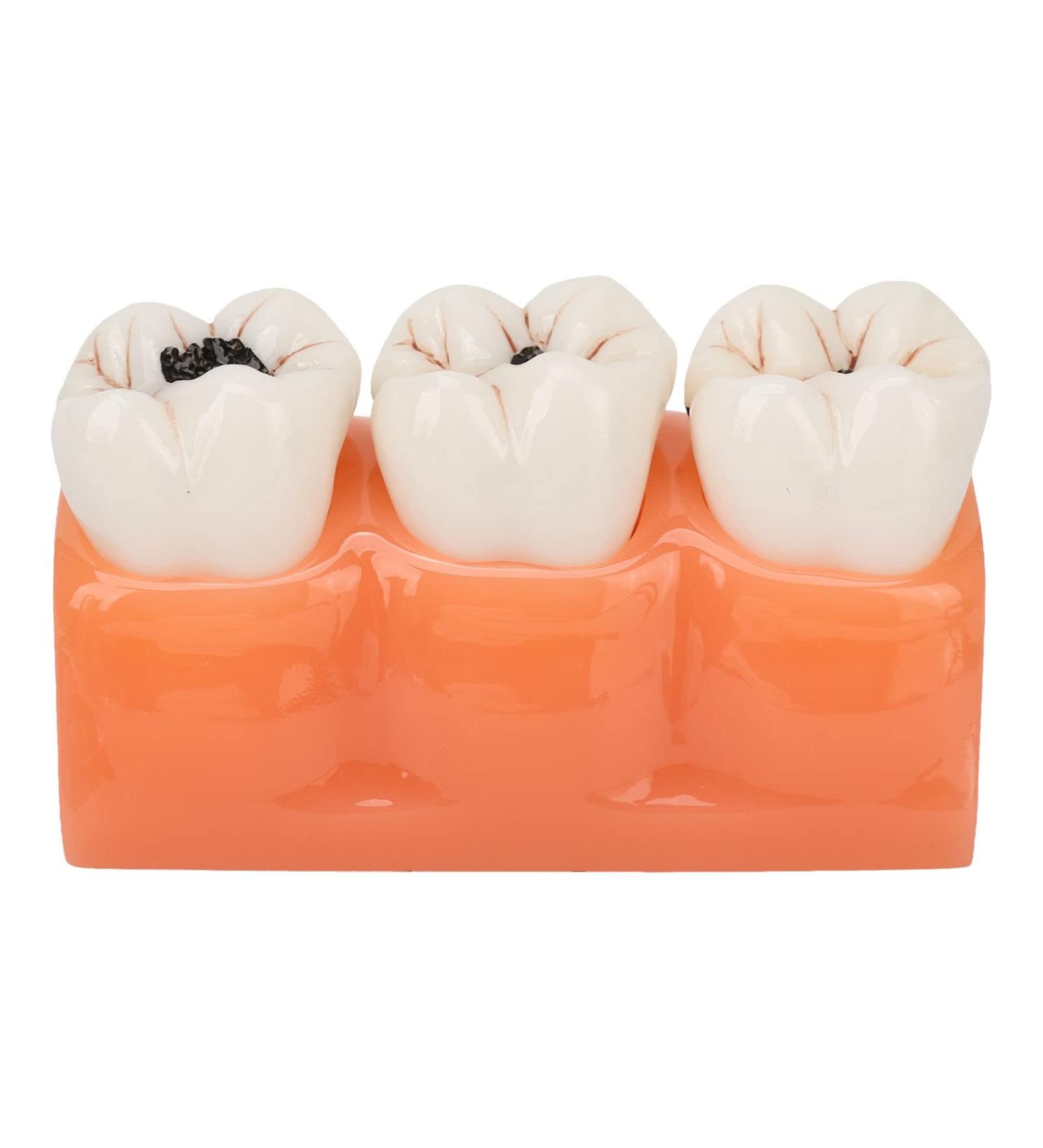 4-Fold Dental Caries Model - Synthetic Resin Oral Care Training Tool for Students | Safe & Realistic Simulation - Buy Online on SooperMarket.com