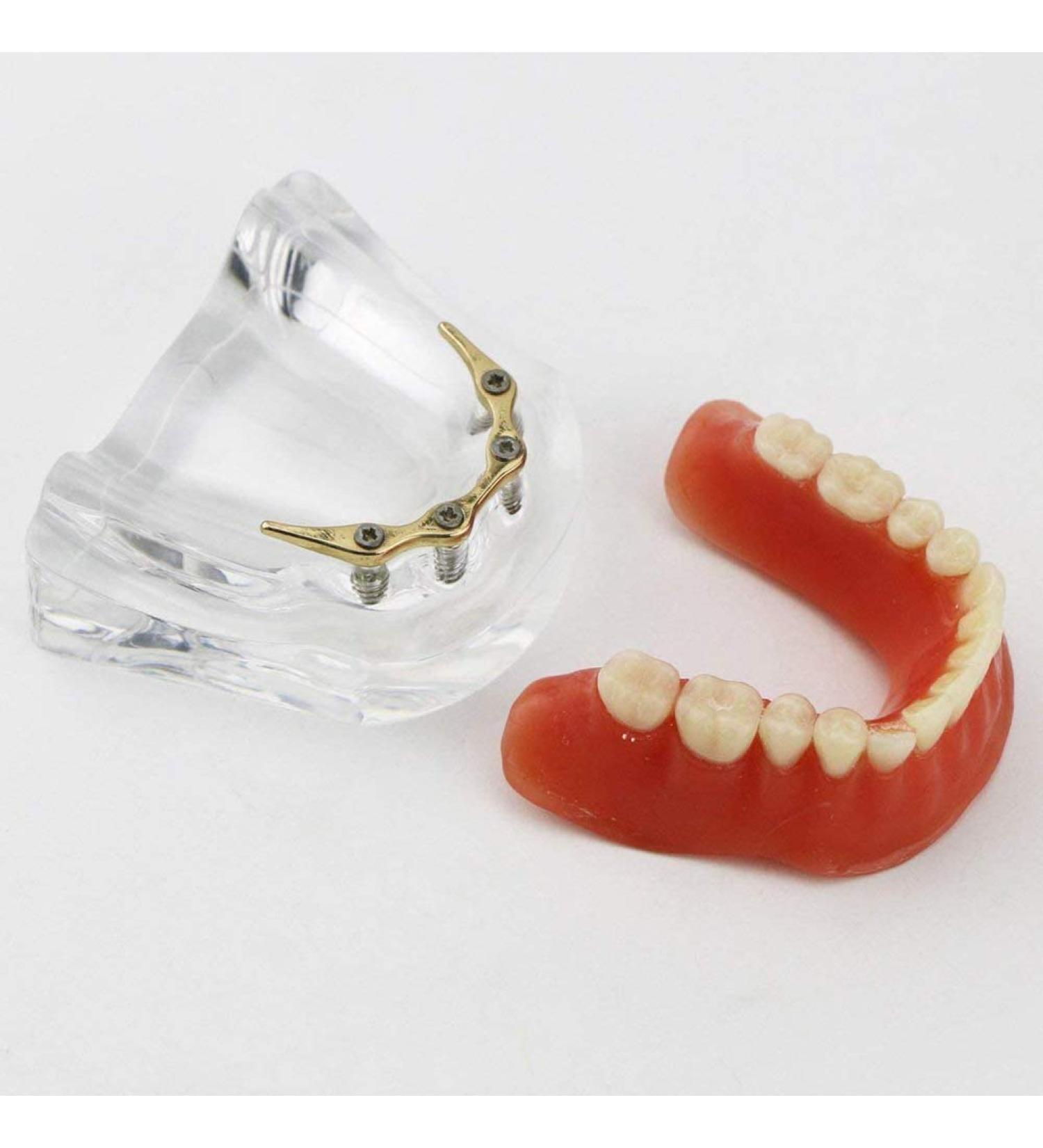Dental Restore Model with 4 implants implant Demonstration Lower Precision Model Dental Teeth Restoration semi-Covered Prosthesis Decoration - Buy Online on SooperMarket.com