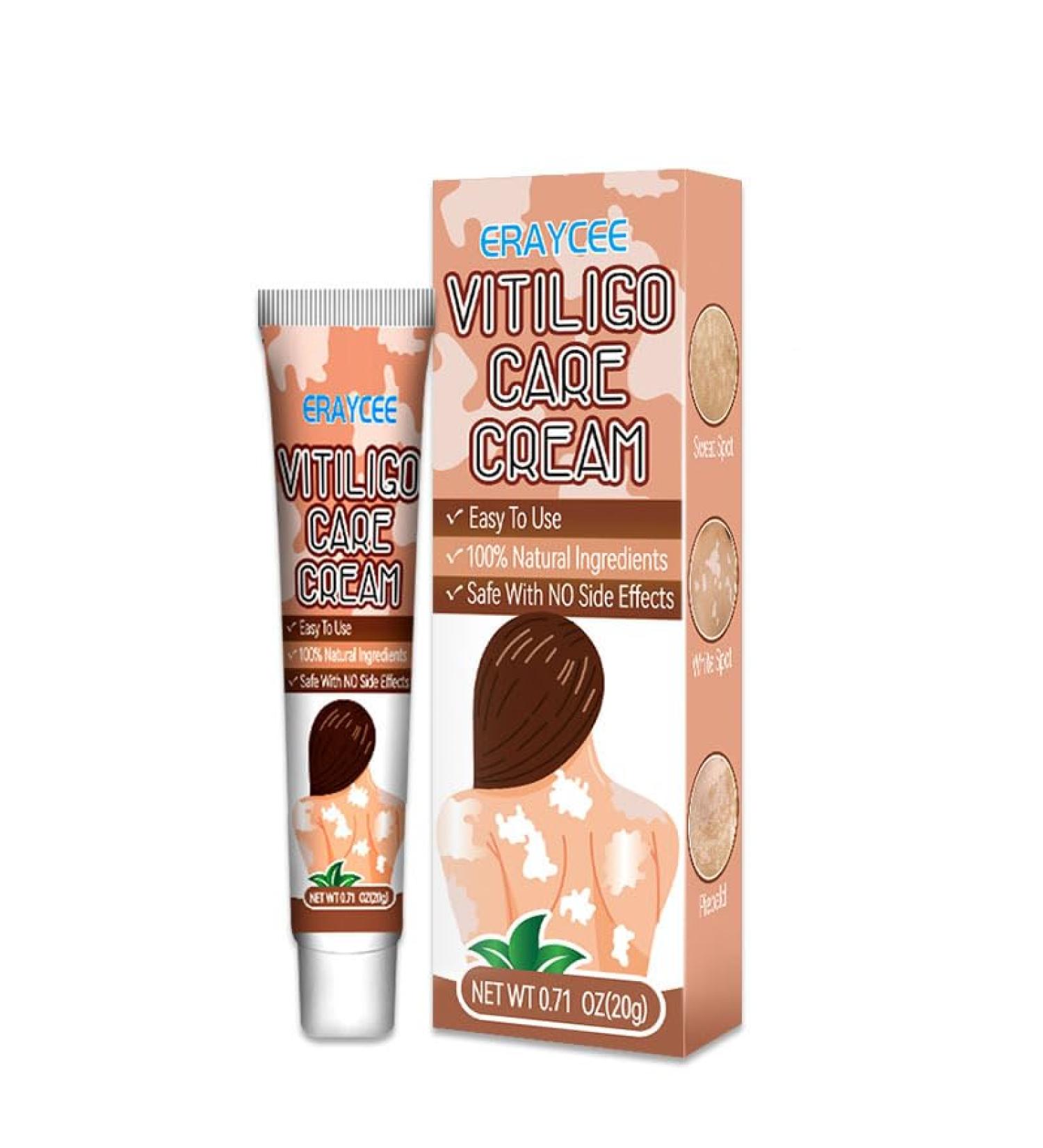 Natural Vitiligo Cream - Effective Treatment to Reduce White Spots & Improve Skin Pigmentation | International Shipping - Buy Online on SooperMarket.com