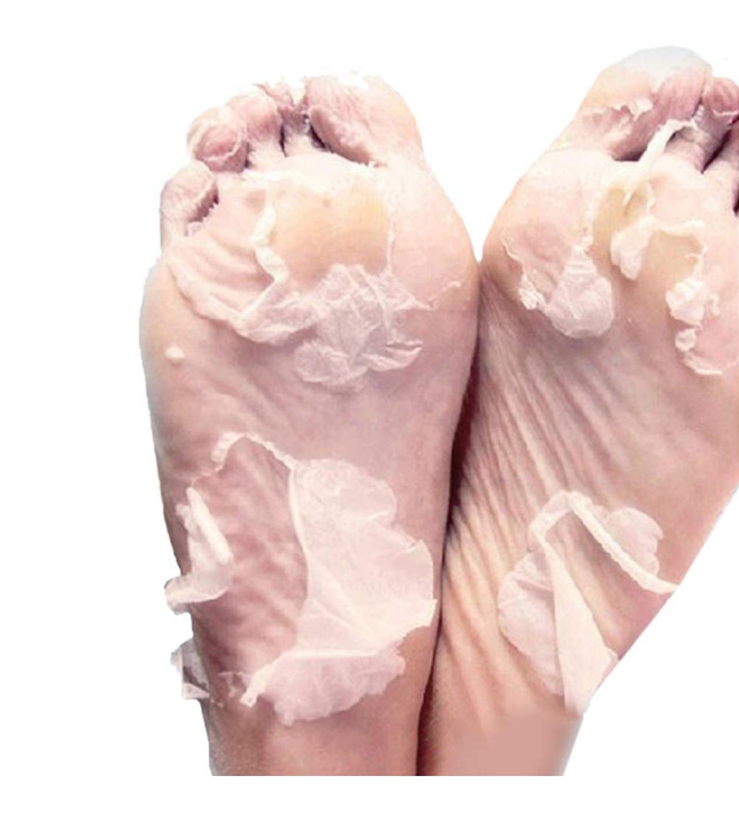 Onkessy Foot Peel Mask - Exfoliating Dead Skin Feet Repair Treatment - For Men and Women - Pedicure Spa - 1 Pair - Buy Online on SooperMarket.com