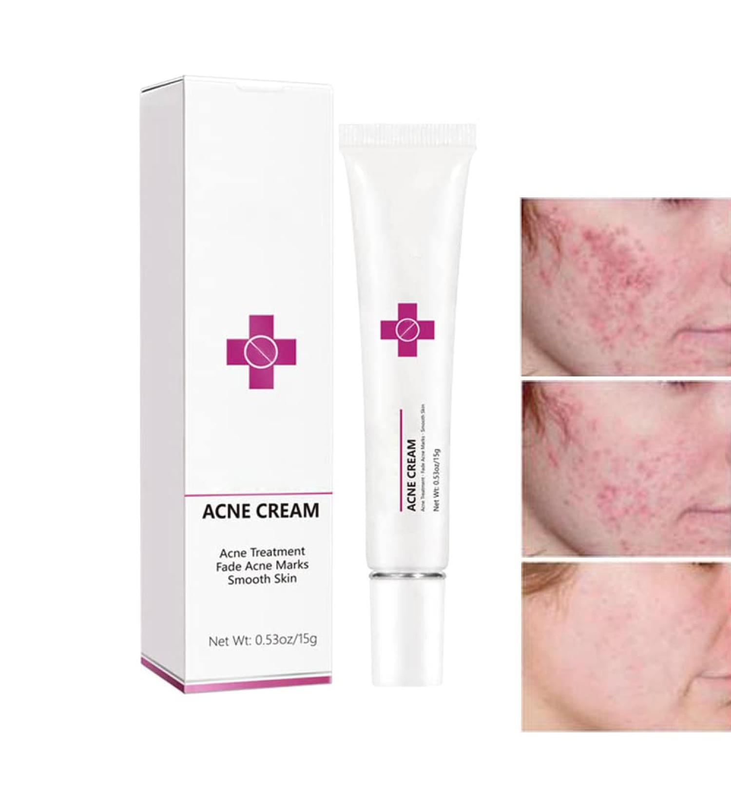 Onkessy Repair Acne Cream - Pimple Treatment for Men and Women - Hydrating & Oil Control Formula for Quick Acne Removal - Buy Online on SooperMarket.com