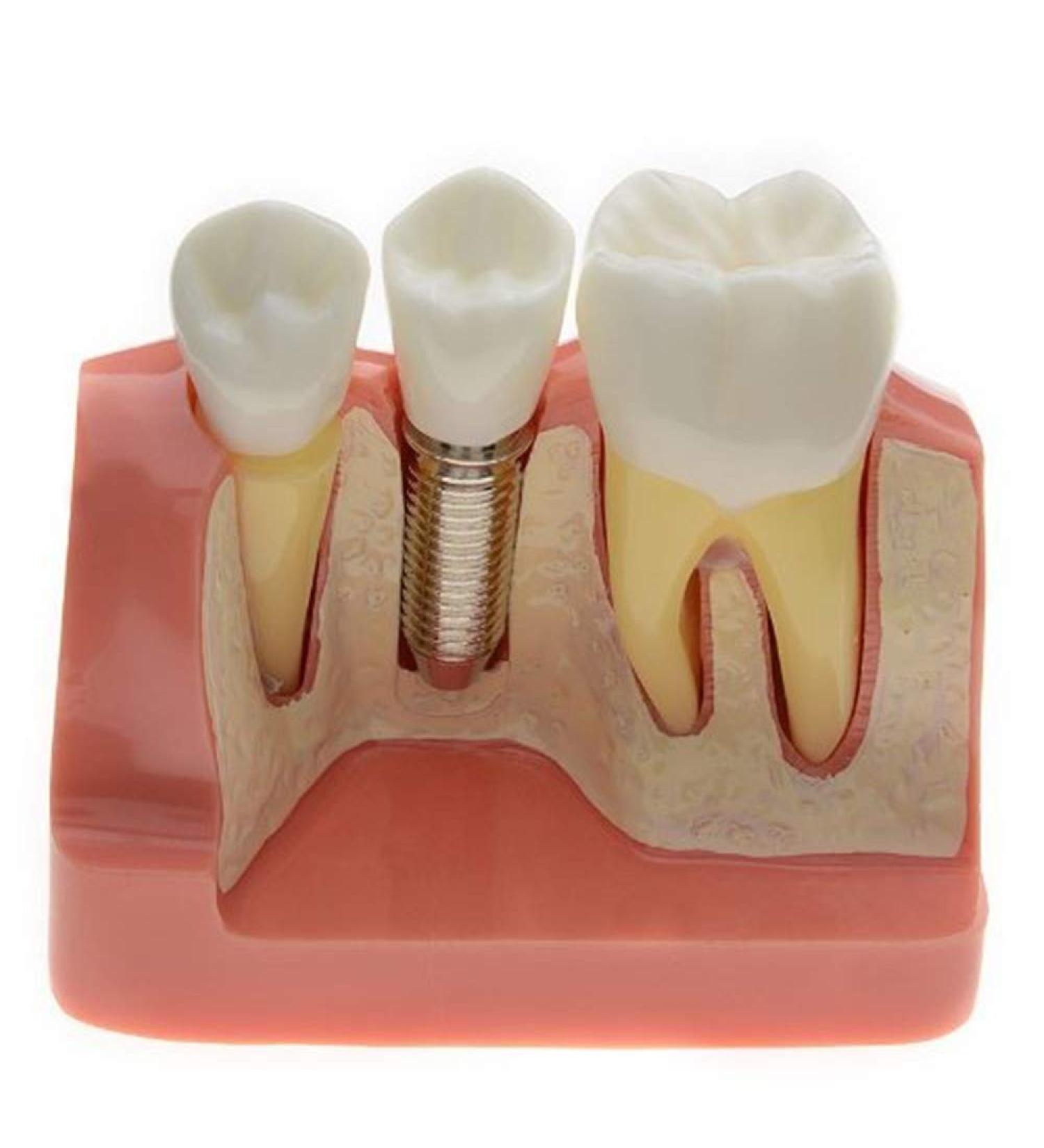 Dental Implant Analysis Demonstration Model - Crown Bridge Teeth Interpretation Model - Buy Online on SooperMarket.com