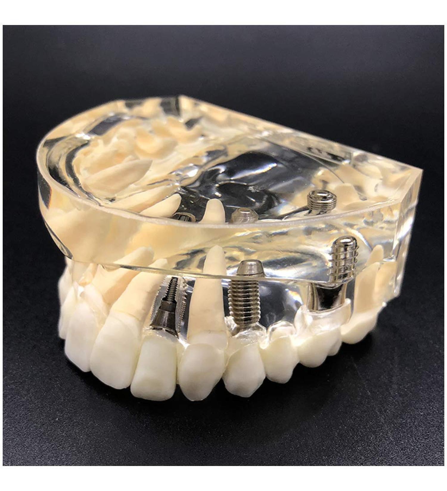 Implant Tooth Template | Oral Simulation Dental Study Model for Teaching - Shop Internationally - Buy Online on SooperMarket.com