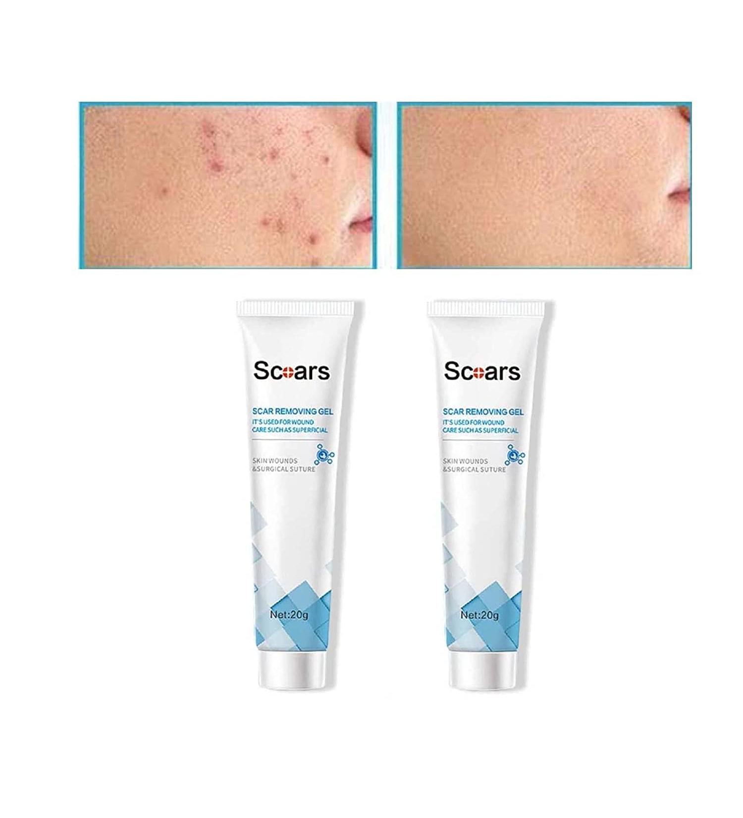 Anshka Organic Scar Removing Gel - Keloid & Surgical Scar Removal Cream for Lightening Scars and Acne Marks - 2pcs - Buy Online on SooperMarket.com