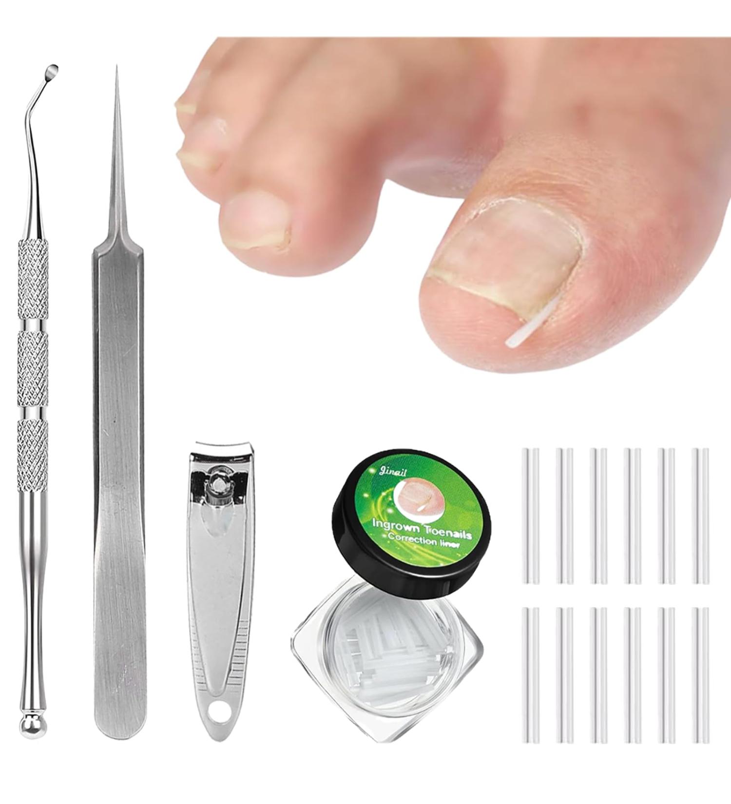 (12 +3) Ingrown Toenail Correction Treatment Kit Toenail Straightener Strips Recover Clips Plastics Ingrown Toenail Correction Strips Brace Kit for Women Men Ingrown Thick Nail - Buy Online on SooperMarket.com