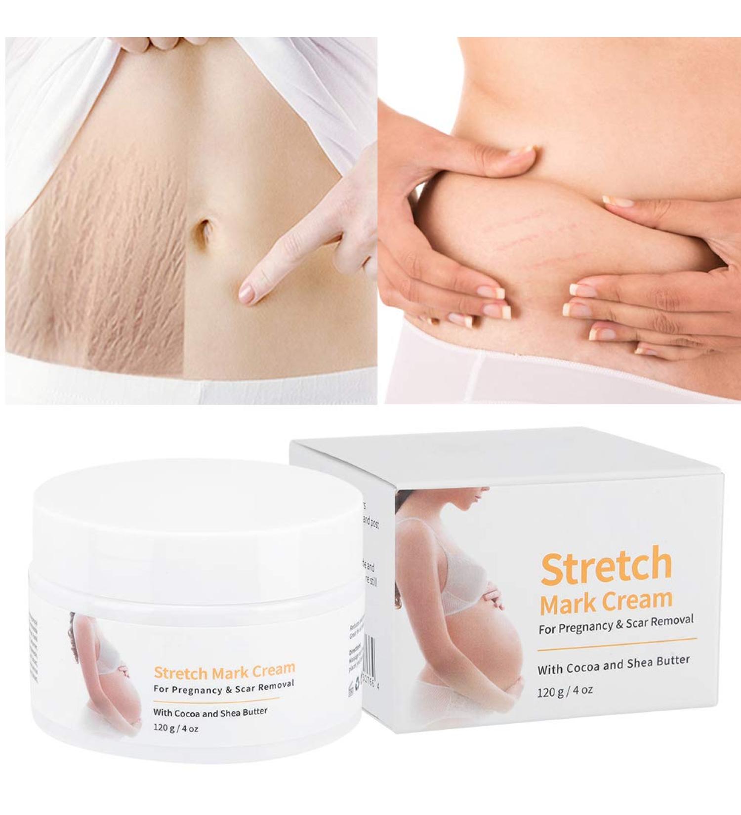 Stretch Stripes Cream 120g | Remove Stretch Marks Pregnancy Scars & Acne | Maternity Repair Treatment - Buy Online on SooperMarket.com