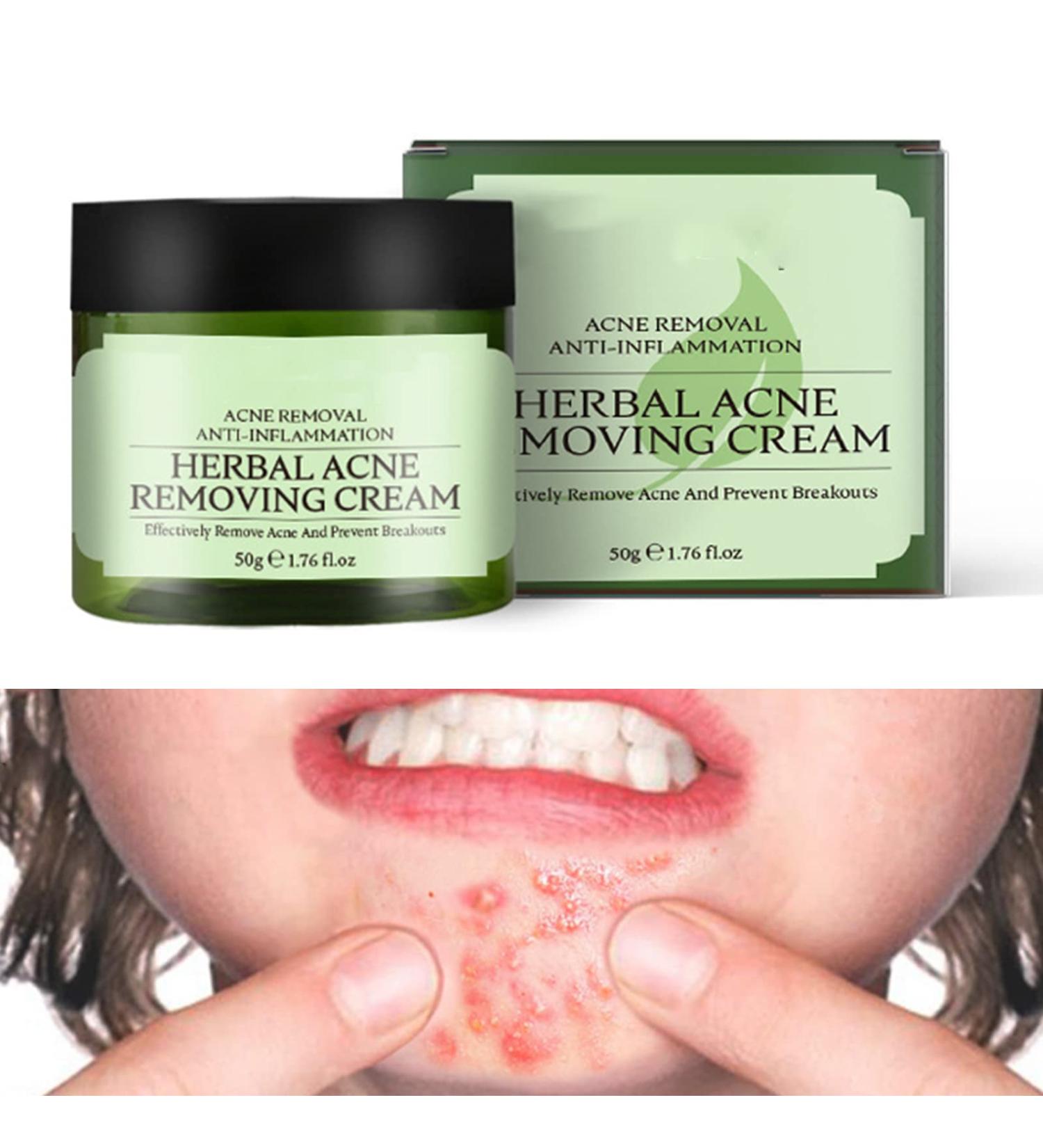 Acne Cream Moisturiser Face Cream Spot Cream Mens Moisturiser Tea Tree Cream Spot Cream For Acne Cream Moisturiser for Women Men Teenagers Dilute Face Prone Spot Marks Balance Facial Oil Cream - Buy Online on SooperMarket.com