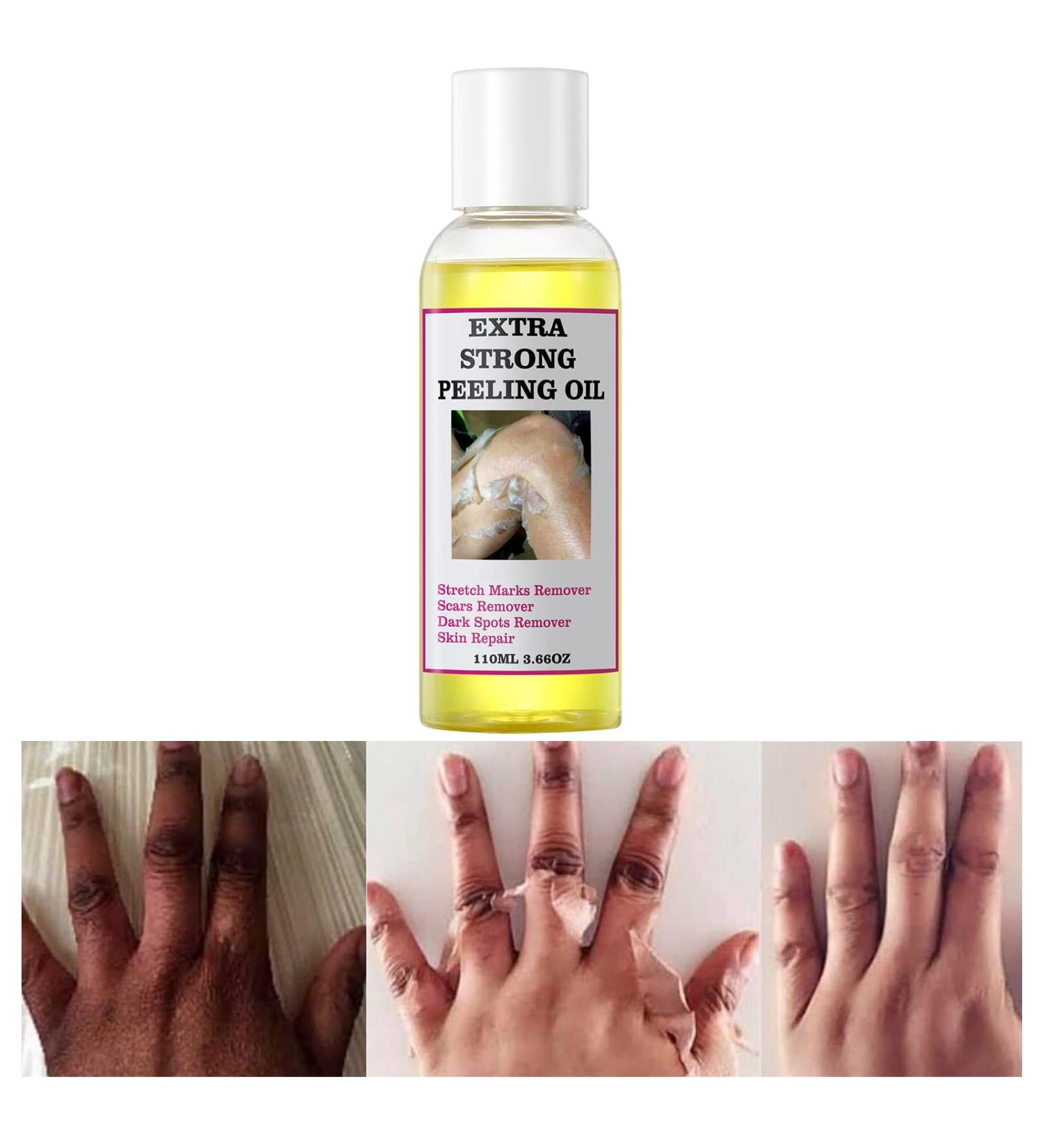 Yellow Peeling Oil for Dark Skin - Strong Extra Strength Exfoliating Solution with Salicylic Sodium Hyaluronate - 110ML/3.66 OZ - Buy Online on SooperMarket.com