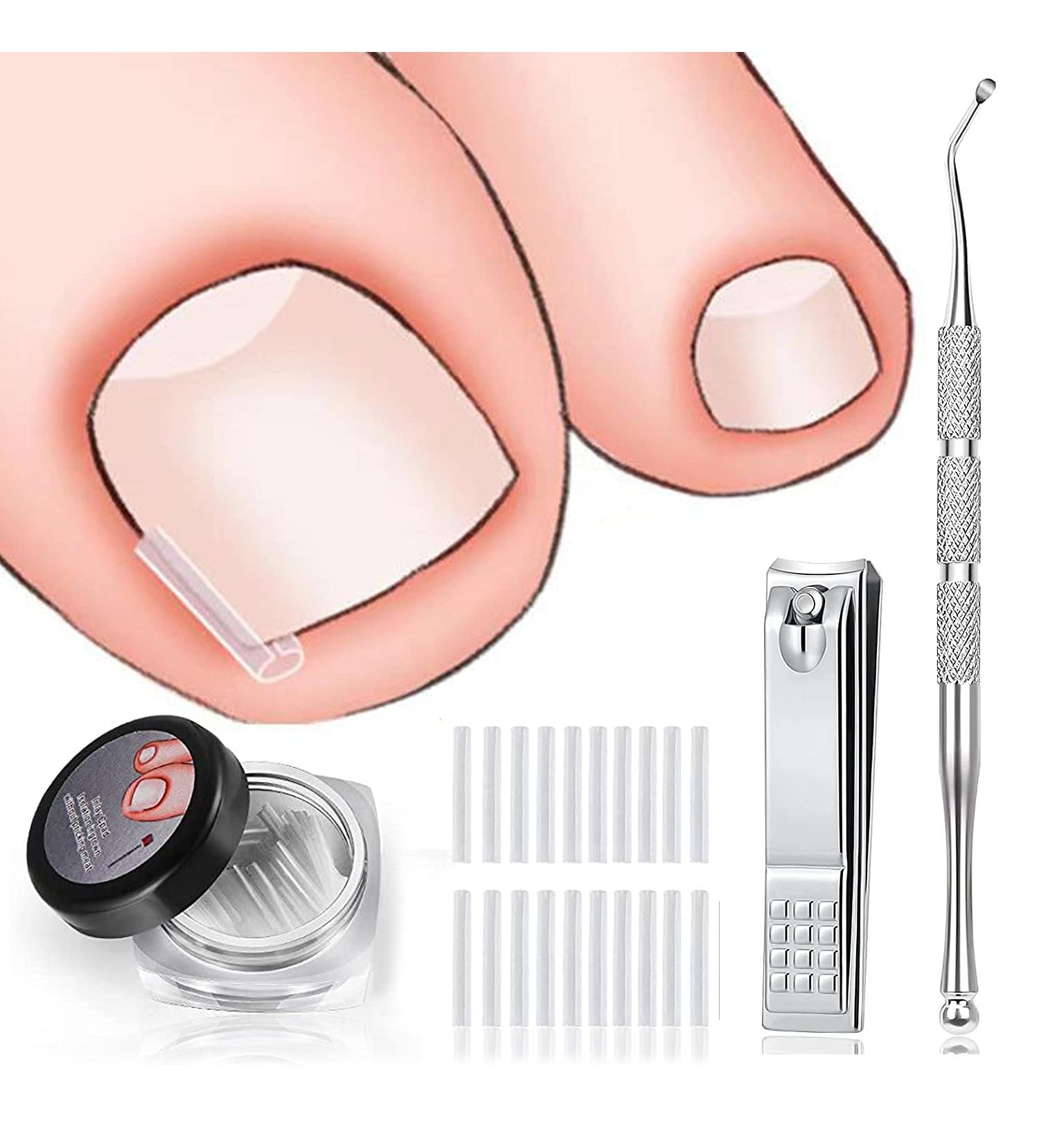 60+2 Pack Ingrown Toenail Treatment Set - Includes Corrector Strips, Lifter, and Nail Clipper - Professional Ingrown Toenail Correction Tool - Buy Online on SooperMarket.com