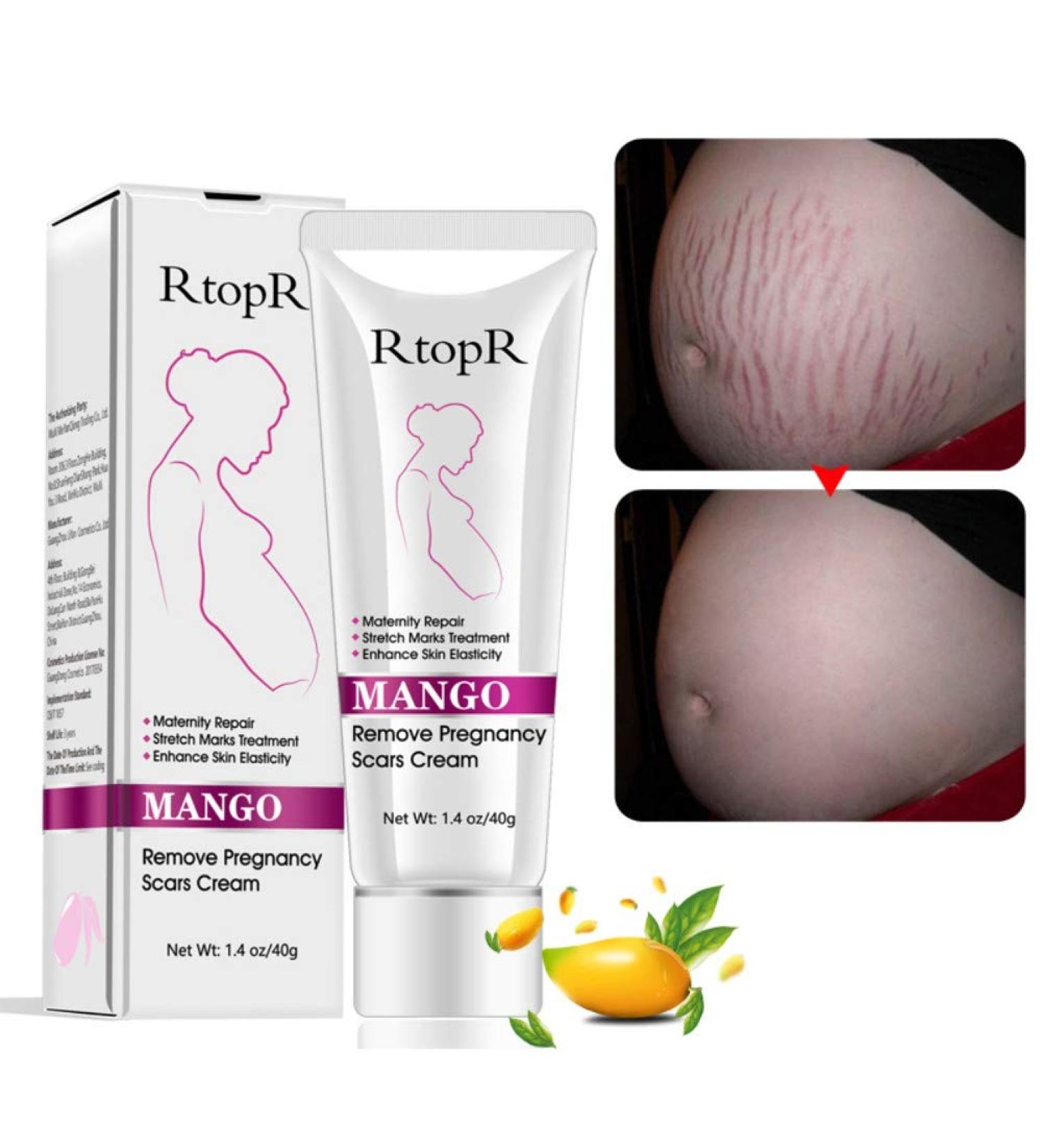 Ofanyia Stretch Mark Removal Cream - Effective Repair for Scars & Pregnancy Marks | International Shipping - Buy Online on SooperMarket.com