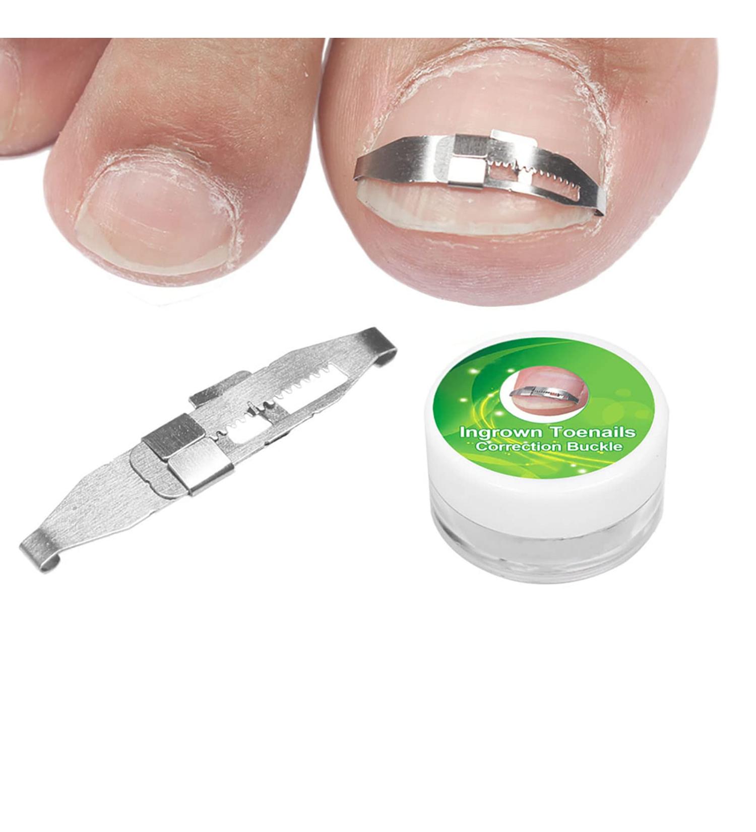 Ingrown Toenail Treatment Stainless Steel Ingrown Toenail Corrector Relief Paronychia Treatment Correcting Tool - Buy Online on SooperMarket.com