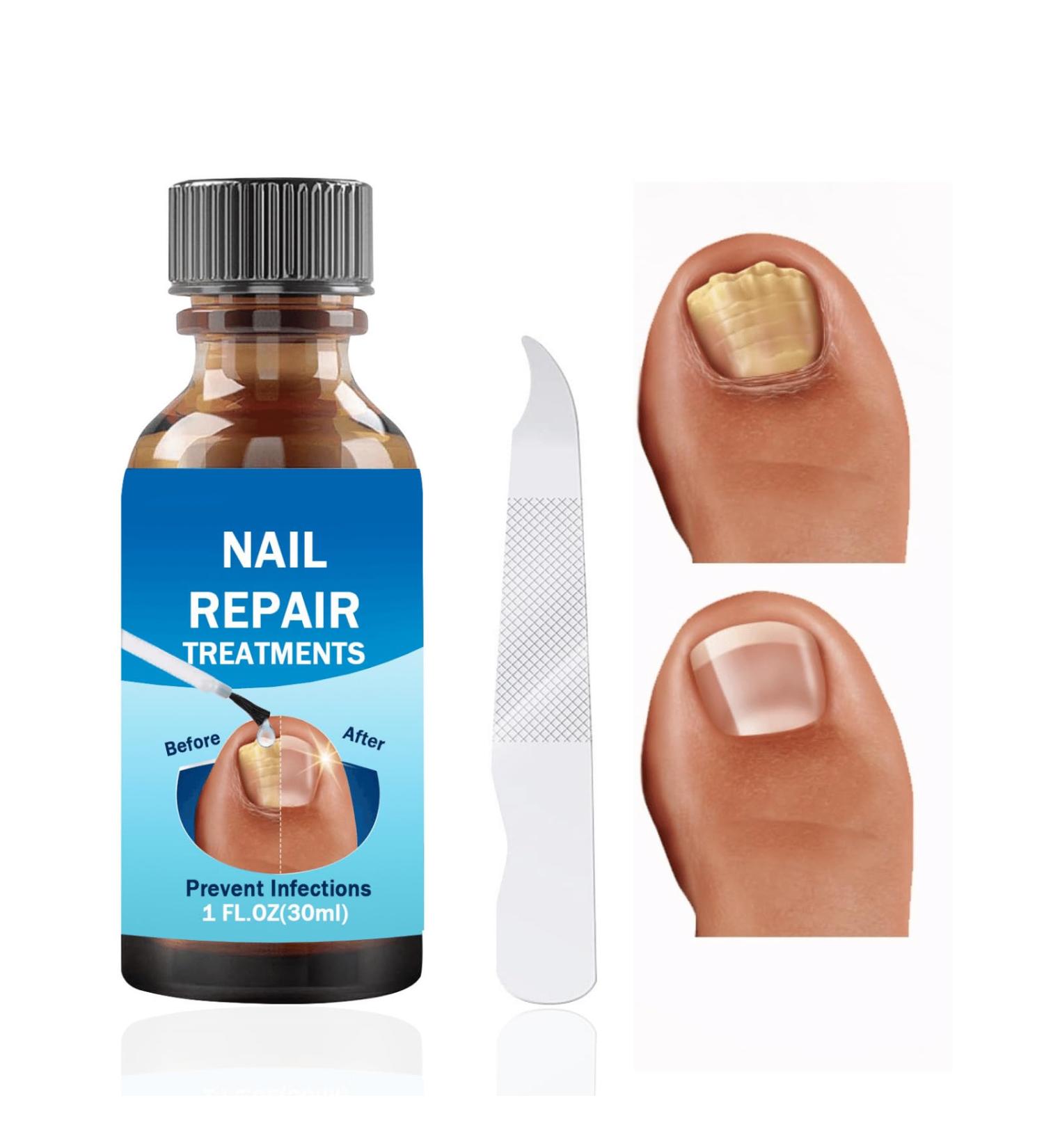 Fungal Nail Treatment 30ML Nail Fungus Serum for Toenail Extra Strong Gentle Anti Fungal Nail Serum Protects Thick Broken Discolored Nails Restoring Healthy Nails For Finger And Toe Nail Fungal - Buy Online on SooperMarket.com