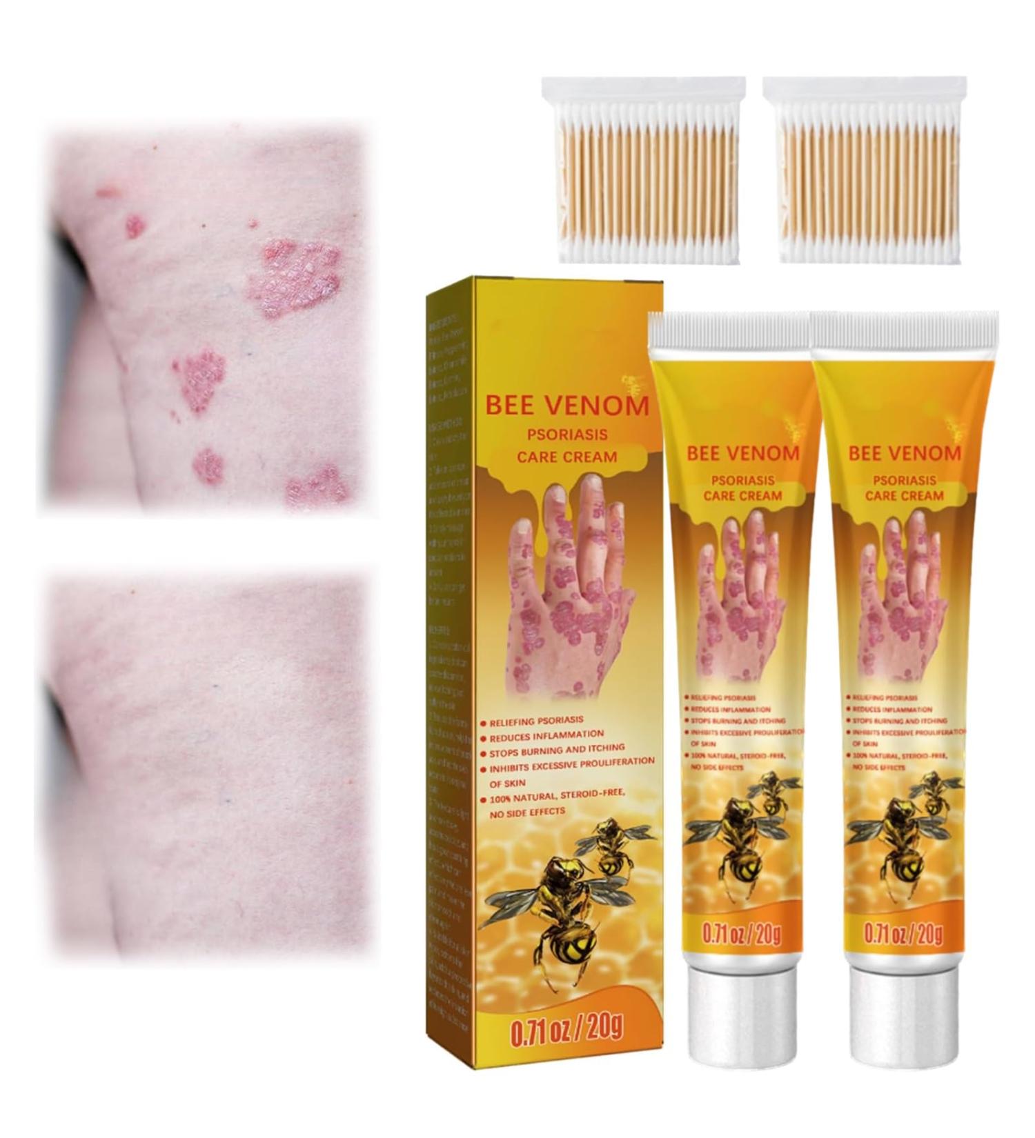 LONGLUAN Youth Bee Venom Anti-Itch Psoriasis Treatment Cream - 2Pcs Set | Soothing & Moisturizing Formula for All Skin Types - Buy Online on SooperMarket.com