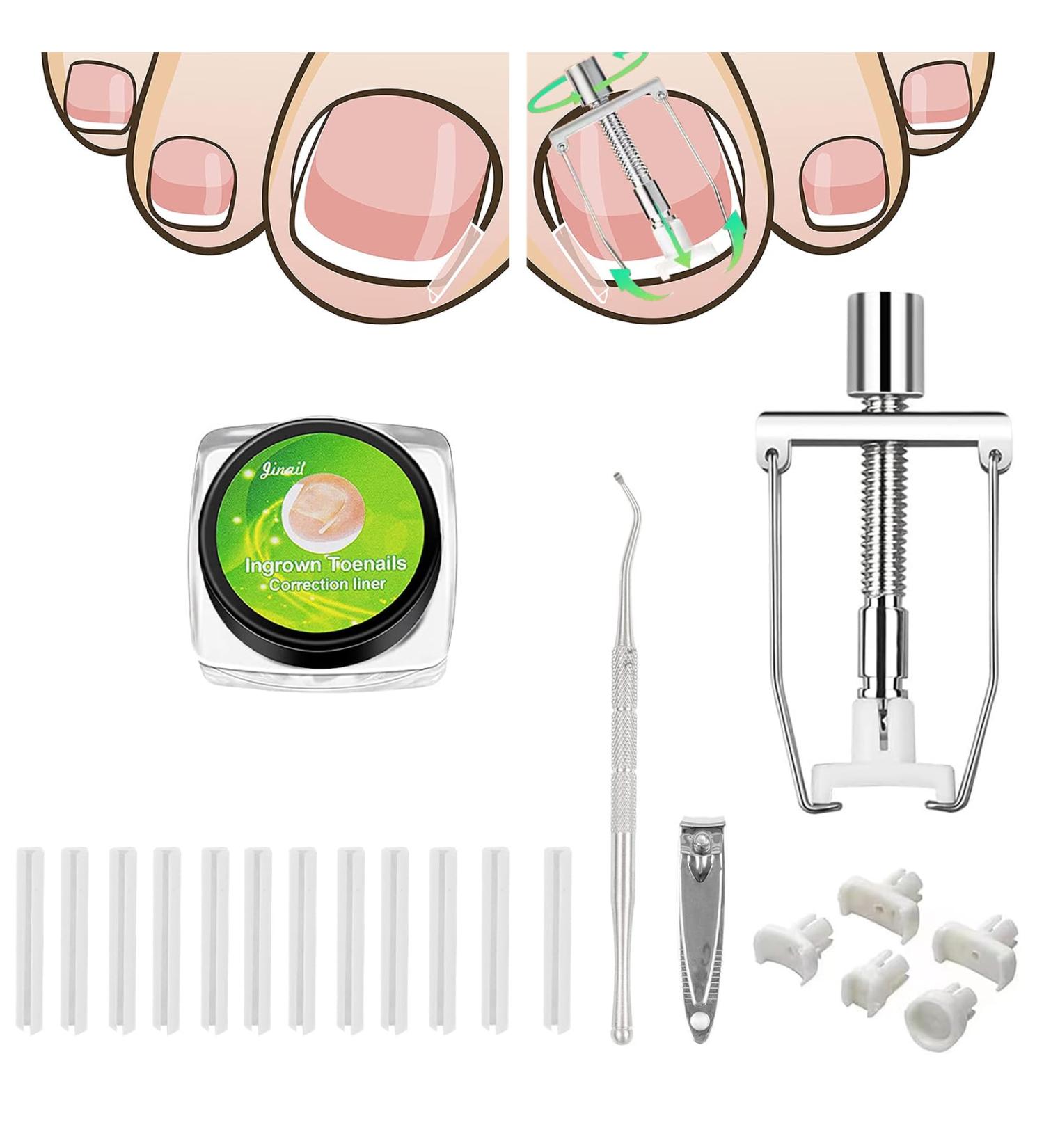 KARELLS Ingrown Toenail Correction Set Ingrown Toenails Set 12 Pieces Ingrown Toenail Lifter Ingrown Toenail Correction Treatment Set for Ingrown Toenails - Buy Online on SooperMarket.com
