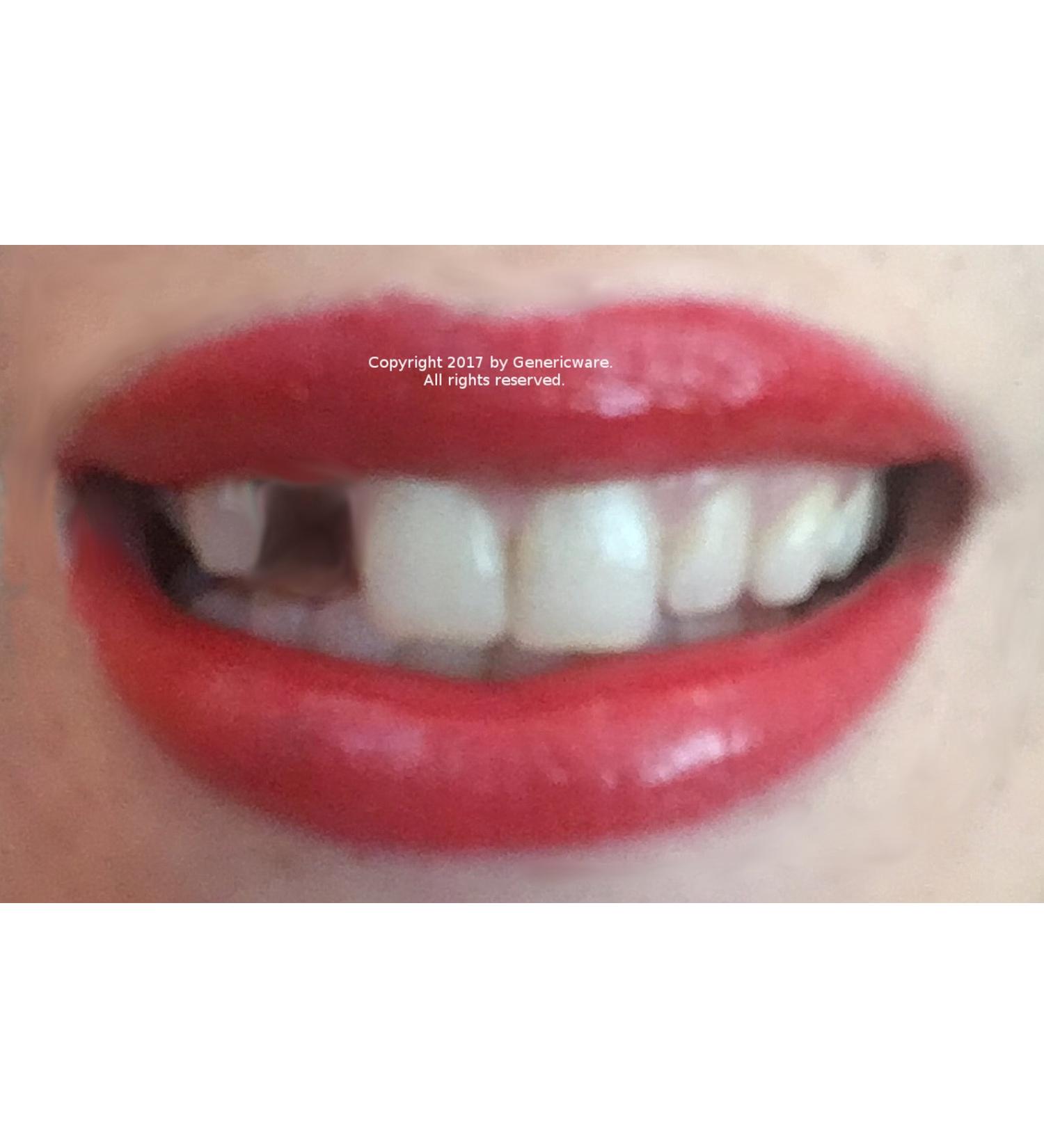 Temporary tooth repair kit temp dental fix missing for 10 teeth! Now with DVD!
