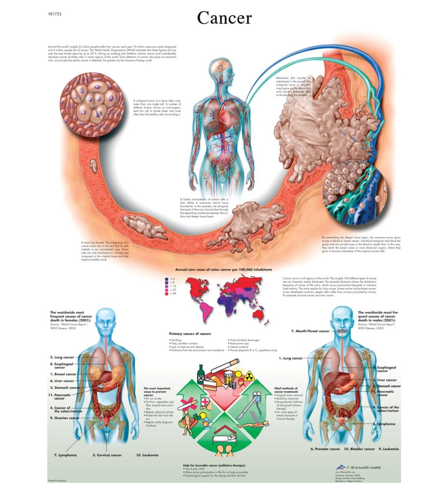 3B Scientific VR1753L Glossy UV Resistant Laminated Paper Cancer Anatomical Chart Poster Size 20-Inch Widthx26-Inch Height