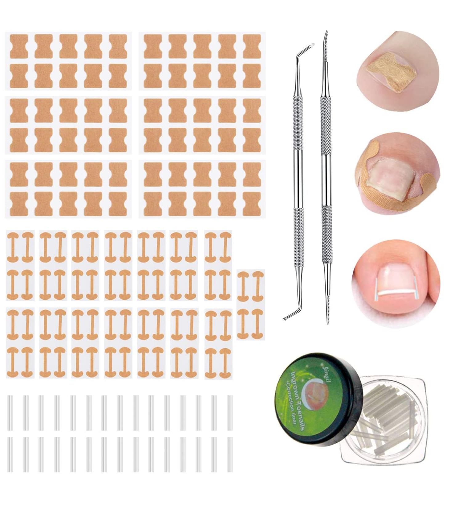 152-Piece Ingrown Toenail Tool Set | Toenail Correction Patch Clasp & Files for Pain Relief - Ship Internationally - Buy Online on SooperMarket.com