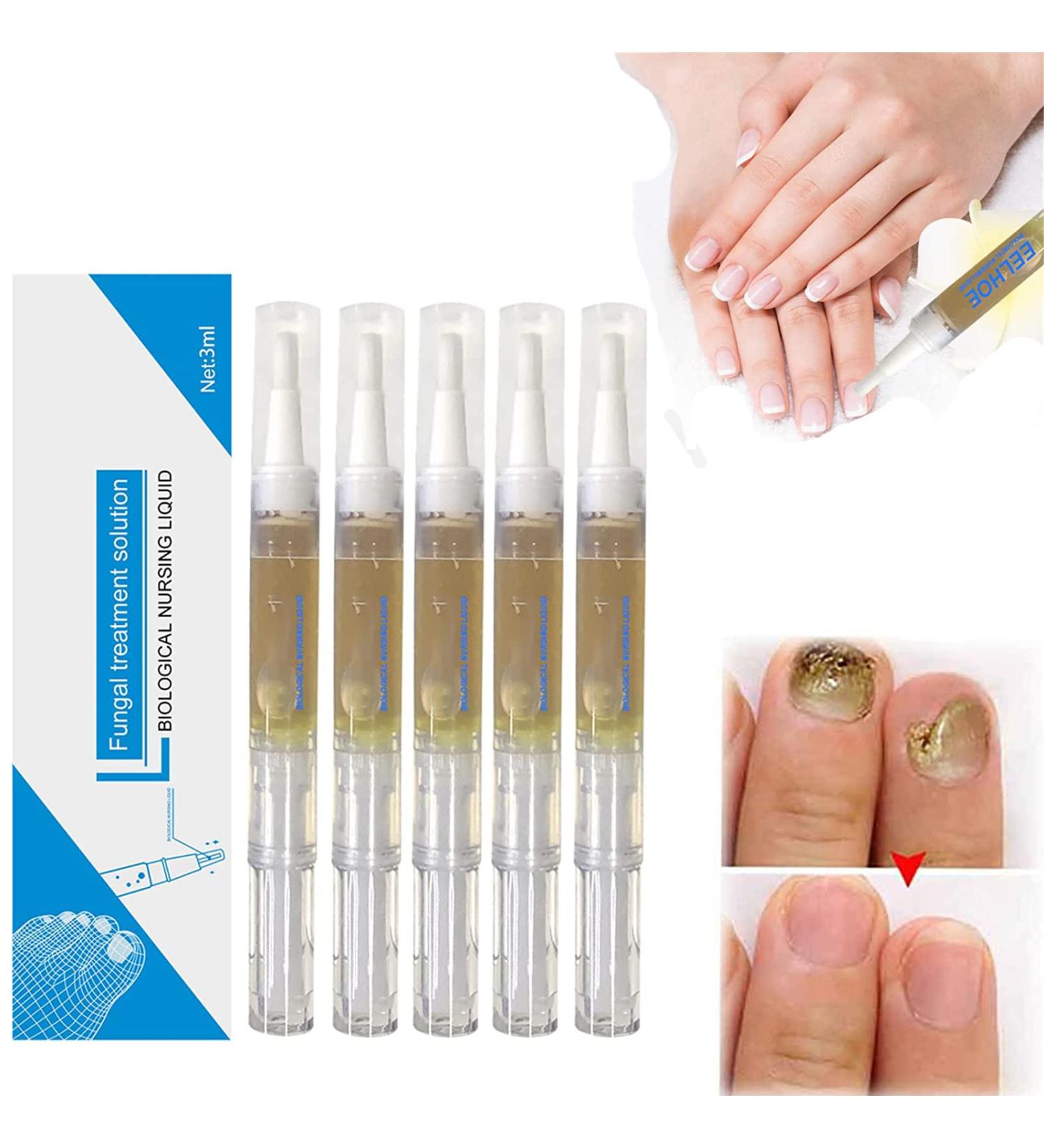 Okita Toenail Fungus Treatment Pen - Effective Nail Repair for Healthy and Strong Nails (5Pcs) - Buy Online on SooperMarket.com