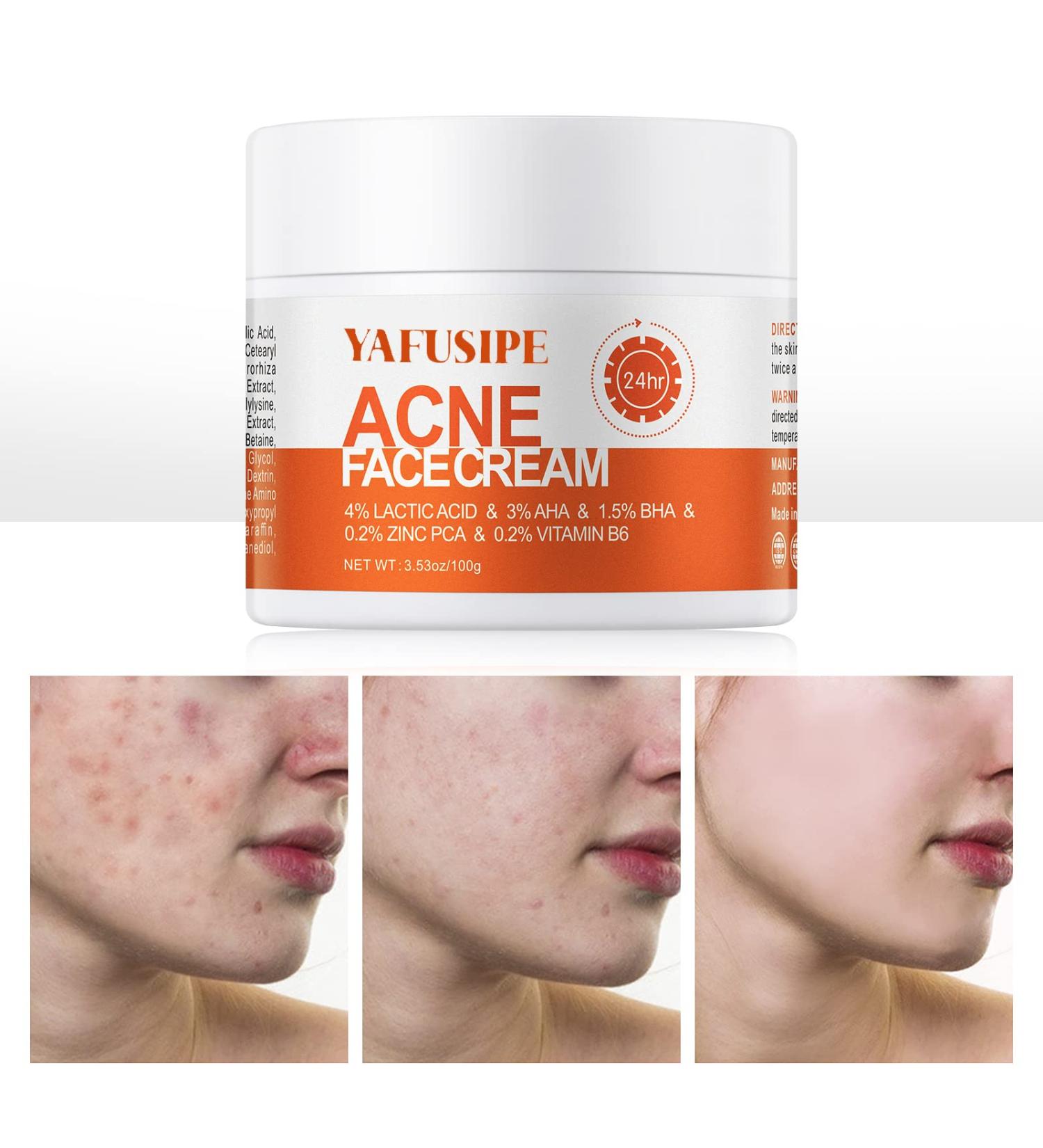 Salicylic Acid Acne Treatment Cream for Face & Body - Teens & Adults | Anti-Acne Moisturizer & Spot Treatment - Buy Online on SooperMarket.com