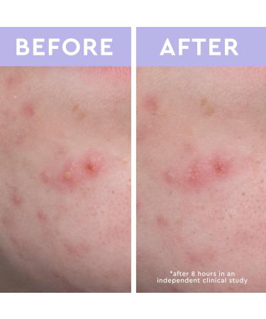 florence by mills Spot a Spot Acne Patches 36 ct - Discover Premium Quality Shop now! - Buy Online on SooperMarket.com