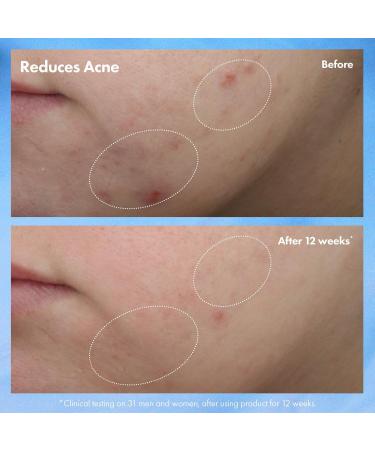 Discover Origins Clear Improvement Acne Clearing Hydrating Lotion 1.7 oz - Elevate Your Style Instantly! - Buy Online on SooperMarket.com