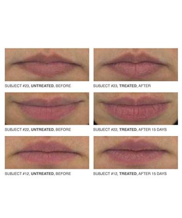PRO Rest rsea Lip Magic - Enhance Your Lips in 15 Days | Paraben & Cruelty-free Lip Care - Buy Online on SooperMarket.com