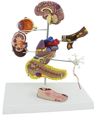 Model Model of Diabetes Complications Heart Pancreas Brain Neuron Model Foot Medical Communication Aids for The Diabetes Demonstration