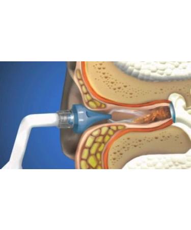 40 Bionix OtoClear Tips - Ear Wax Removal & Cleaning System - Buy Online on SooperMarket.com
