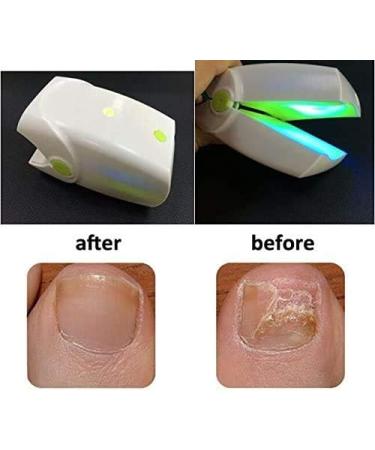 Rechargeable Nail Fungus Laser Treatment Onychomycosis Treatment for Onychomycosis Cure and Home Use - Buy Online on SooperMarket.com