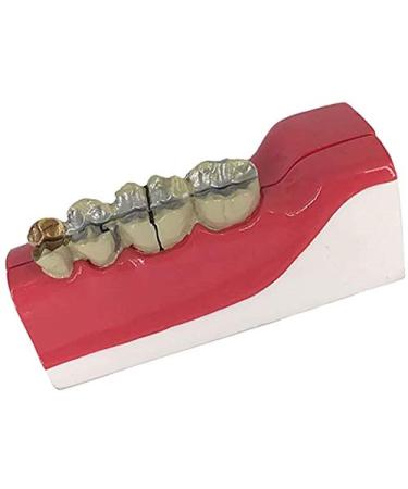 LBYLYH Model of Teeth Teeth Adult Replica Model Doctor Removable Dental Realistic Teaching Tissuedecompositionmodel