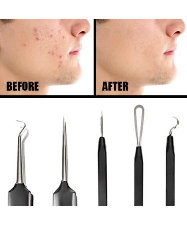 Pete & Pedro Acne & Blackhead Remover Tool Set - 5 Piece Pimple Popper Kit + Mirror | For Men & Women | Removes Whiteheads, Zits, Blackheads, Comedones | Seen on Shark Tank - Buy Online on SooperMarket.com
