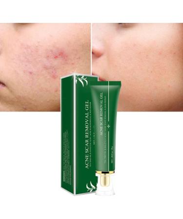 Acne Scar Removal Gel Face Body Marks Skin Repair Cream Acne Treatment Essence 30g acne removal cream - Buy Online on SooperMarket.com