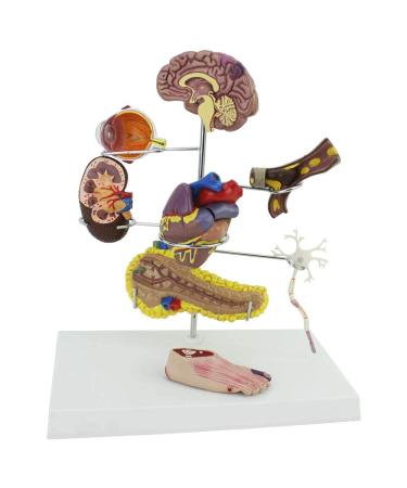 Model of Diabetes Model of complications Brain Heart Pancreas neurone Foot Patient Patient Doctor aids to The Demonstration of Diabetes