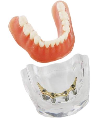 Dental Restore Model with 4 implants implant Demonstration Lower Precision Model Dental Teeth Restoration semi-Covered Prosthesis Decoration - Buy Online on SooperMarket.com
