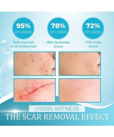Anshka Organic Scar Removing Gel - Keloid & Surgical Scar Removal Cream for Lightening Scars and Acne Marks - 2pcs - Buy Online on SooperMarket.com