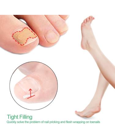 Ingrown Toenail Correction Patch Ingrown Correction Sticker 46 Pieces Ingrown Toenail Correction Patch Care Ingrown Nail Patch for Men Women - Buy Online on SooperMarket.com