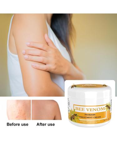 Bee Venom Cream Bee Venom Psoriasis Cream for All Skin Types Easy Application & No Irritation 30g - Buy Online on SooperMarket.com