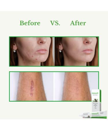 Kelosoft - Natural Scar Removal Cream Keloid Scar Removal Gel Plant Based Herbal Scar Cream Helps Reduce Visibility of Scars - 25g - Buy Online on SooperMarket.com