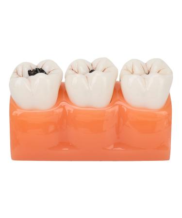 4-fold caries model dental caries model made of synthetic resin safe simulation for professional oral care training students