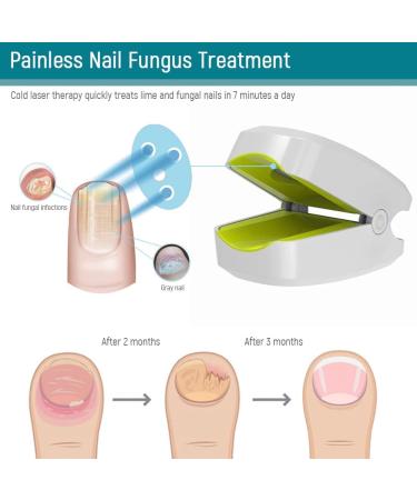 Lanlousy 905NM Nail Therapeutic Instrument Portable Painless Nail Therapy Device Anti- Silicone Easy to Use White - Buy Online on SooperMarket.com
