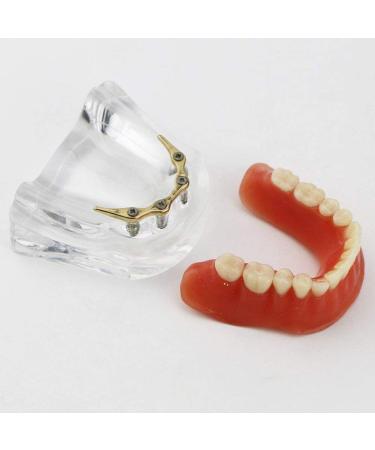 Dental Restore Model with 4 implants implant Demonstration Lower Precision Model Dental Teeth Restoration semi-Covered Prosthesis Decoration