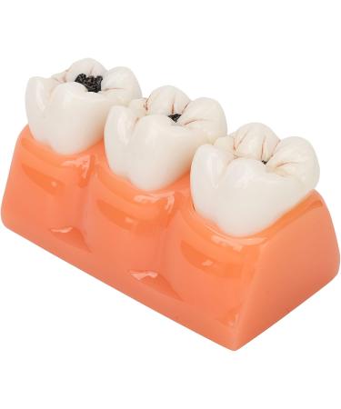 4-Fold Dental Caries Model - Synthetic Resin Oral Care Training Tool for Students | Safe & Realistic Simulation - Buy Online on SooperMarket.com