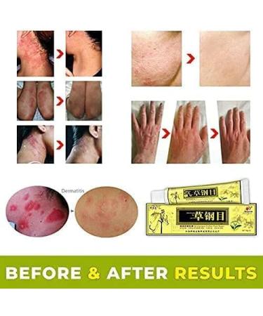 Natural Herbal Cream for Itching Allergy, Dry Skin Relief - Eczema Treatment - Buy Online on SooperMarket.com