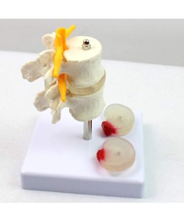 Model of Human Spine Detachable Medical Teaching Model Lumbar Spine Injuries with 2 Intervertebral Disc Model Model - Buy Online on SooperMarket.com