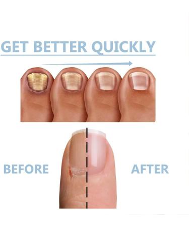 HOPASRISEE Onyxoguard Nail Growth and Repair Serum Onyxoguard Serum Nail Strengthener Nail Growth Serum Nail Growth and Strengthener Nail Serum for Strength and Growth (1) - Buy Online on SooperMarket.com