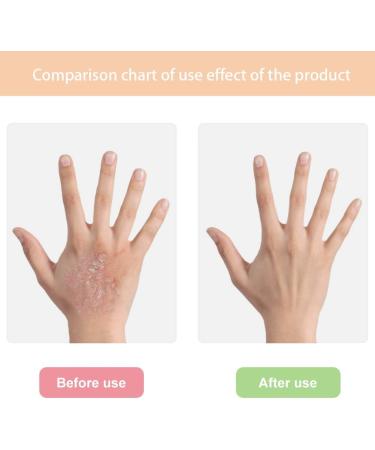 Bee Venom Cream Bee Venom Psoriasis Cream for All Skin Types Easy Application & No Irritation 30g - Buy Online on SooperMarket.com