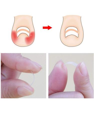 Toenail Tool 6 in 1 Ingrown Toe Nail Fixer Pedicure Toenail Recover Nail Foot Care Kit Ingrown Toenail Corrector for Men Women(24pcs) - Buy Online on SooperMarket.com