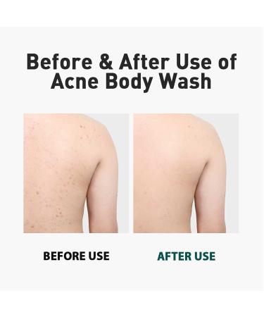 Dashu Daily Acne Relax Body Wash 16.9fl oz - Cooling Acne Treatment - Buy Online on SooperMarket.com
